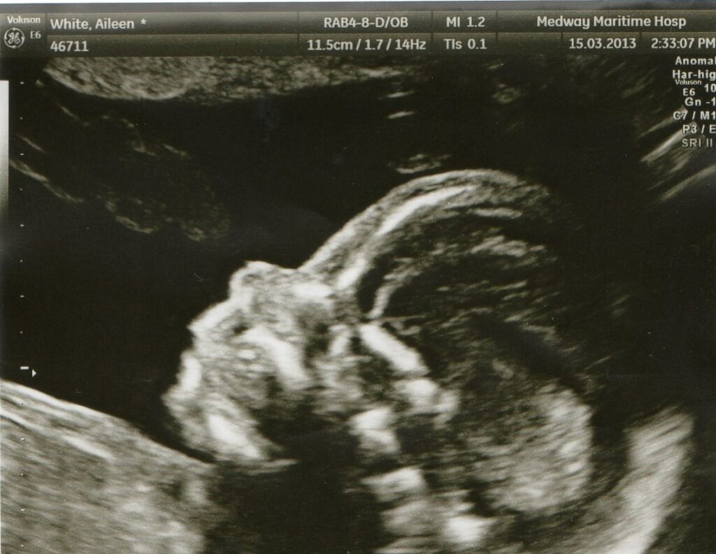 My Birth Preparation: black and white picture of a baby ultrasound